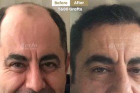 este-surgery-before-after-23